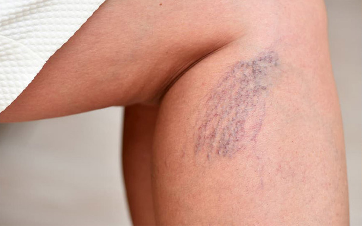 Capillary Varicose Vein Treatment