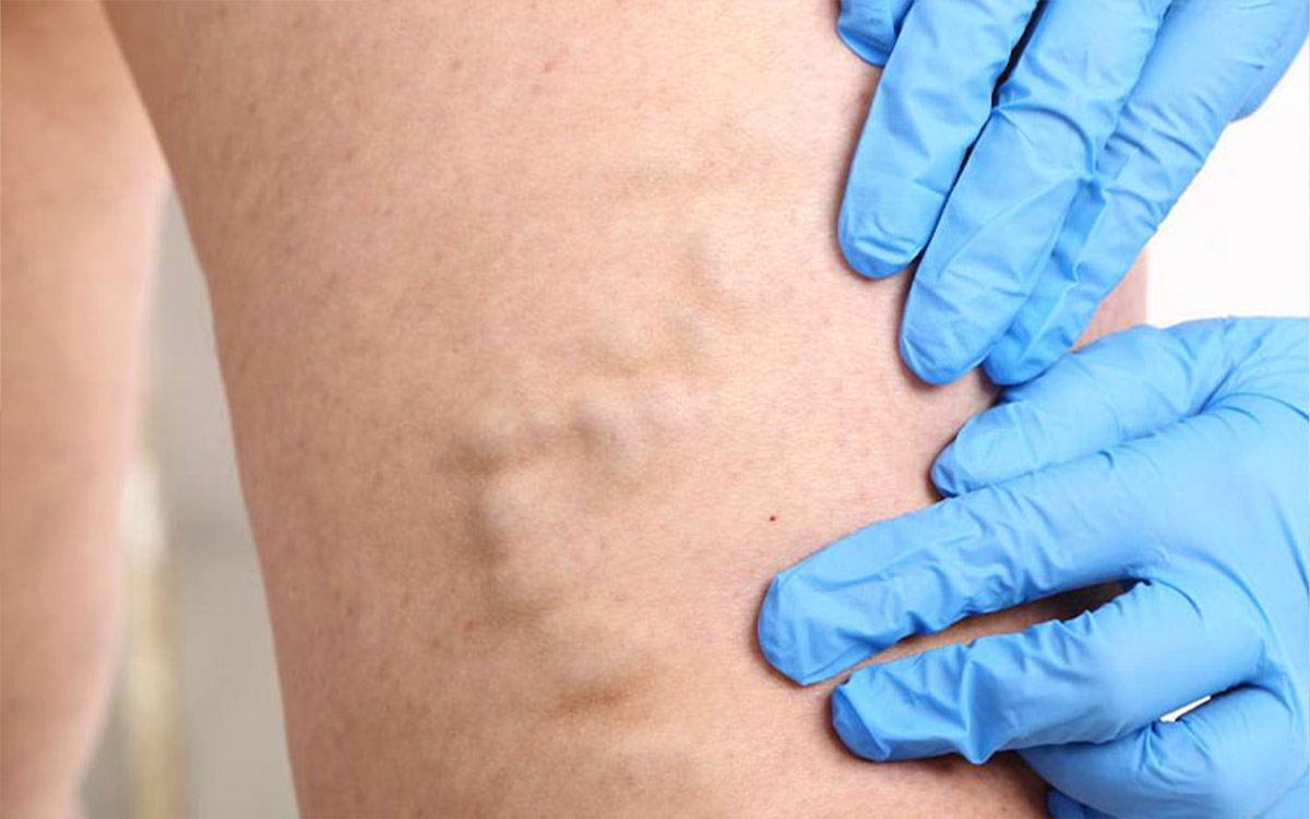 Foam Treatment for Varicose Veins