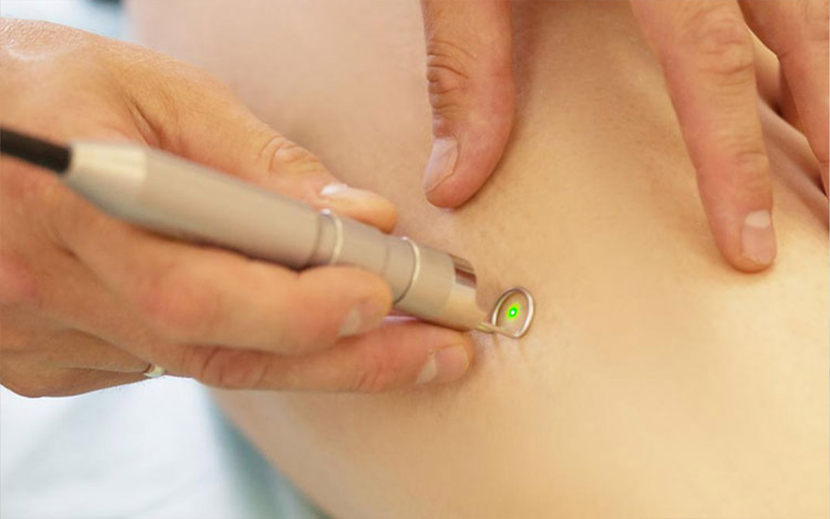 Transdermal Laser Treatment for Varicose Veins