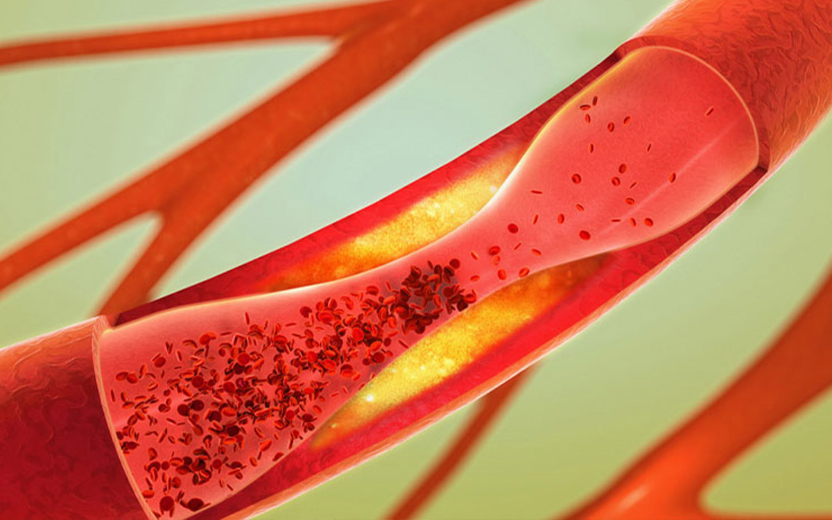 Peripheral Artery Disease Symptoms