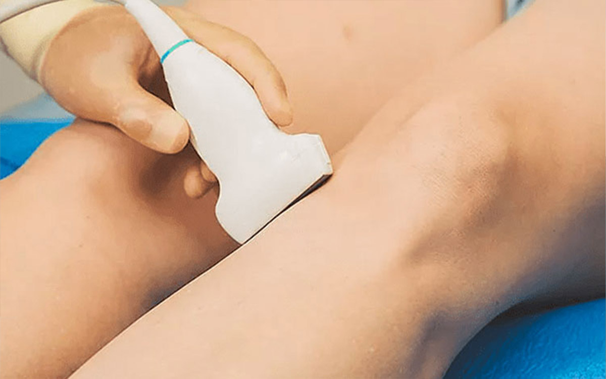 Transdermal Radiofrequency for Varicose Vein Treatment