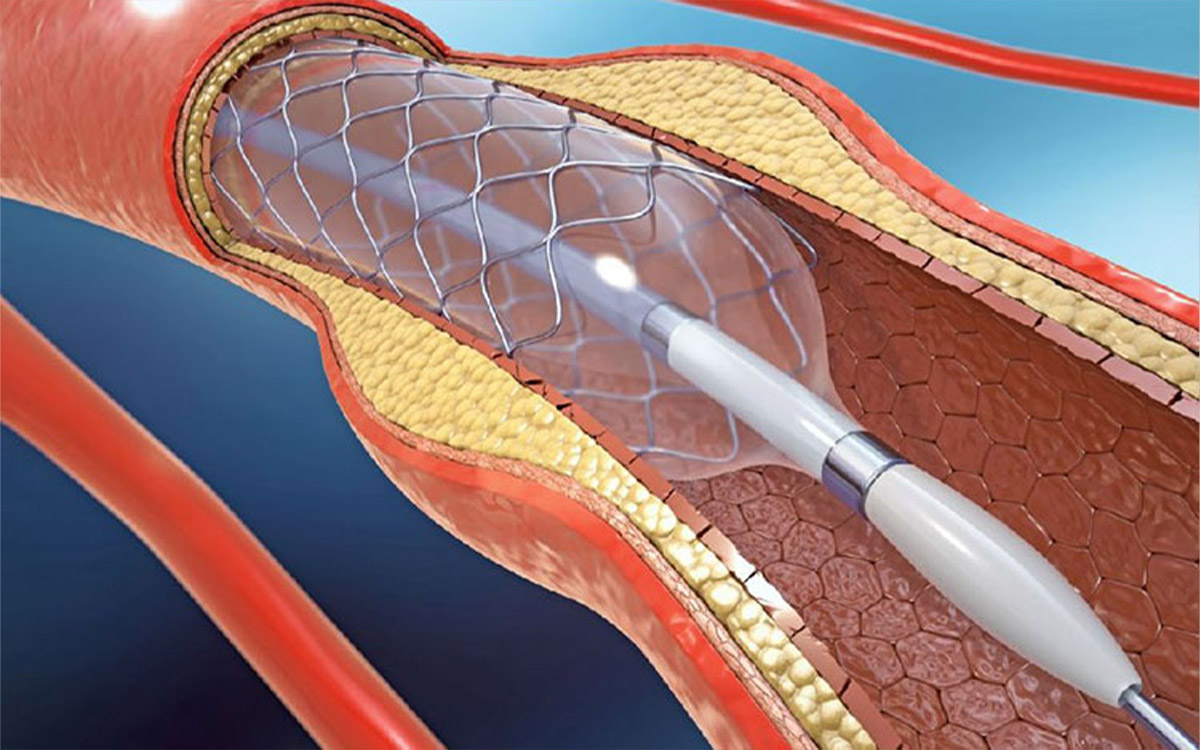 Placing a Stent on Carotid Artery