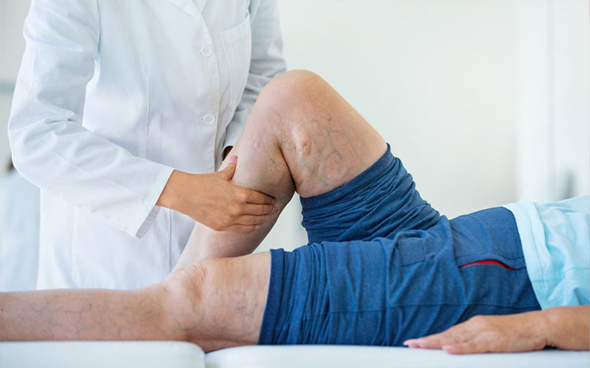 What to Do Before the Aesthetic Treatment of Varicose Veins?