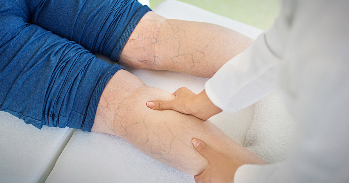 What Can I Do About My Varicose Veins?